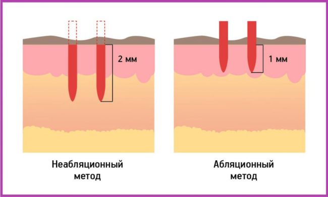 Схема абляционного и неабляционного воздействия